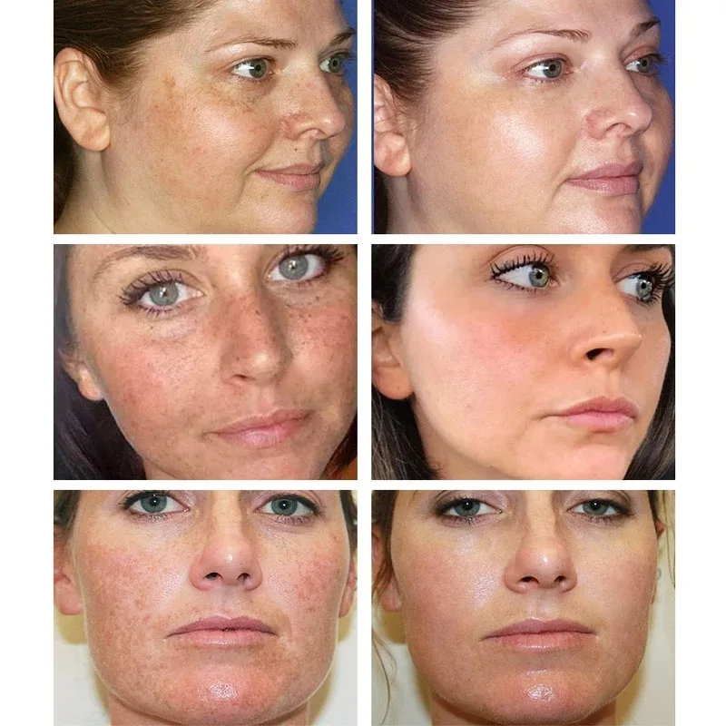Clareamento creme de sardas re - Retinol Cream avaliação e preço